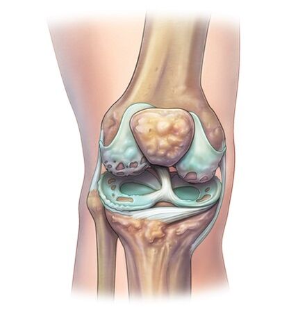 Zniszczenie stawów z rozwojem osteochondrozy