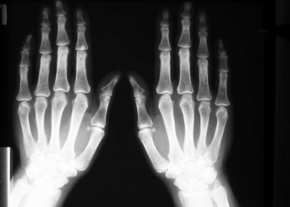 prześwietlenie w celu zdiagnozowania bólu stawów palców