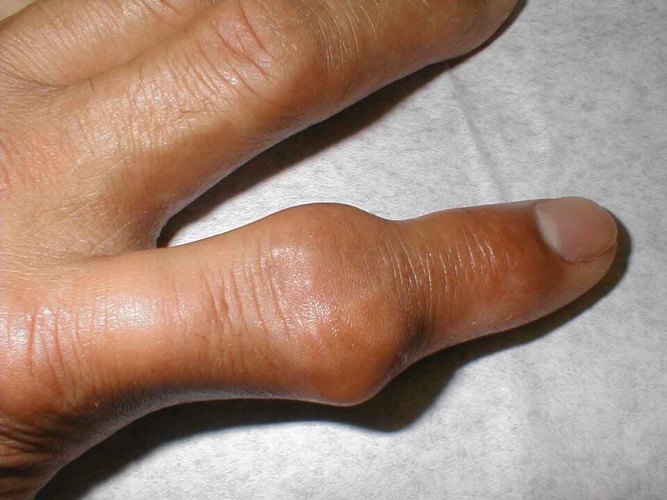 tophi w stawie palca jako przyczyna bólu